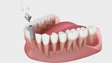 dental-implants-for-seniors:-the-best-solution-for-long-term-oral-health