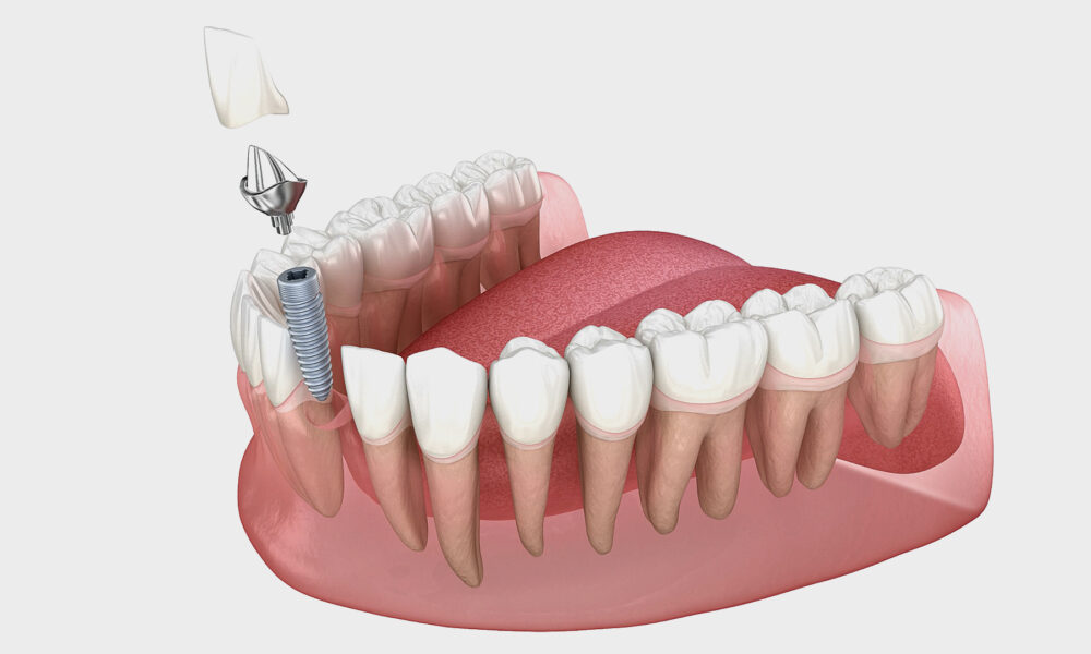 dental-implants-for-seniors:-the-best-solution-for-long-term-oral-health